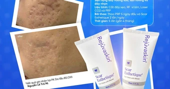 Cách mờ sẹo mụn sau laser: Giảm viêm, hỗ trợ lành thương và tái tạo thể tích