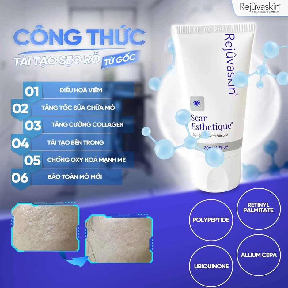 Cách ngừa sẹo sau mụn hiệu quả tại nhà theo khoa học Cách ngừa sẹo sau mụn hiệu quả tại nhà theo khoa học