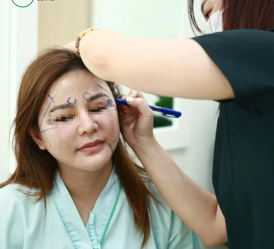 Căng da mặt không sẹo, tương lai của trẻ hóa da mặt không dao kéo Căng da mặt không sẹo, tương lai của trẻ hóa da mặt không dao kéo