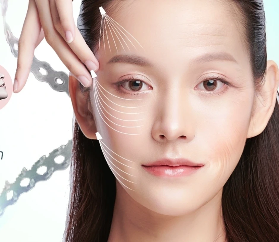 Căng da mặt không sẹo, tương lai của trẻ hóa da mặt không dao kéo Căng da mặt không sẹo, tương lai của trẻ hóa da mặt không dao kéo