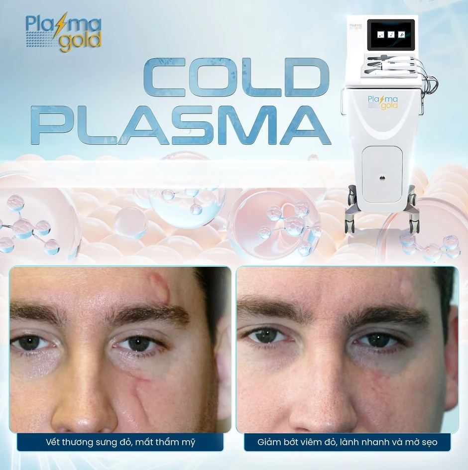 Chuyên gia bất ngờ ứng dụng của Plasma lạnh hiệu quả sau 1 liệu trình Chuyên gia bất ngờ ứng dụng của Plasma lạnh hiệu quả sau 1 liệu trình