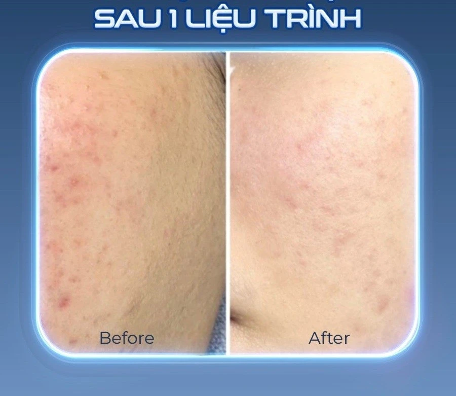 Chuyên gia bất ngờ ứng dụng của Plasma lạnh hiệu quả sau 1 liệu trình Chuyên gia bất ngờ ứng dụng của Plasma lạnh hiệu quả sau 1 liệu trình