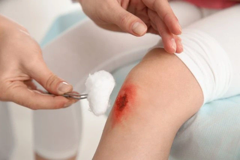 Chuyên gia nói gì về việc chọn kem bôi vết thương để ngừa nhiễm trùng và sẹo? Chuyên gia nói gì về việc chọn kem bôi vết thương để ngừa nhiễm trùng và sẹo?