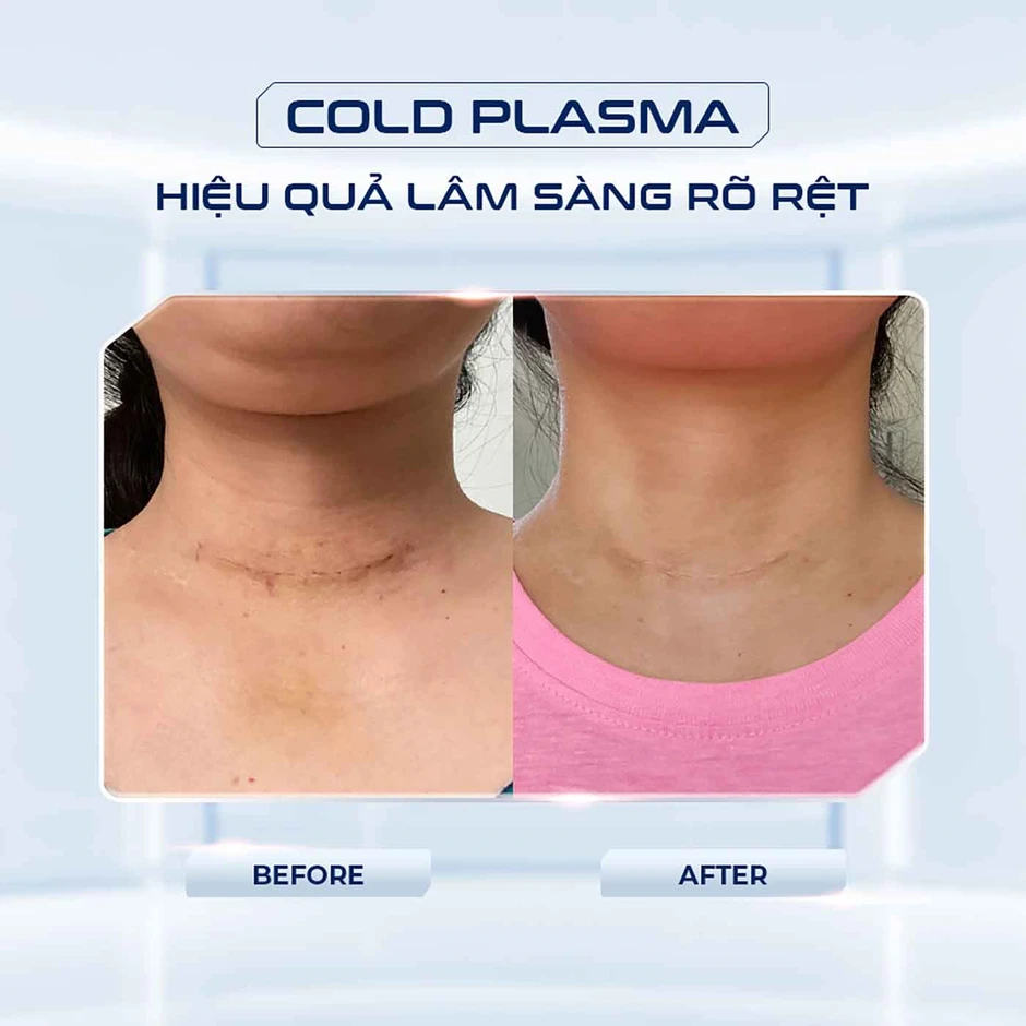 Cold Plasma trong hỗ trợ phục hồi vết thương: Cơ chế và ứng dụng lâm sàng Cold Plasma trong hỗ trợ phục hồi vết thương: Cơ chế và ứng dụng lâm sàng