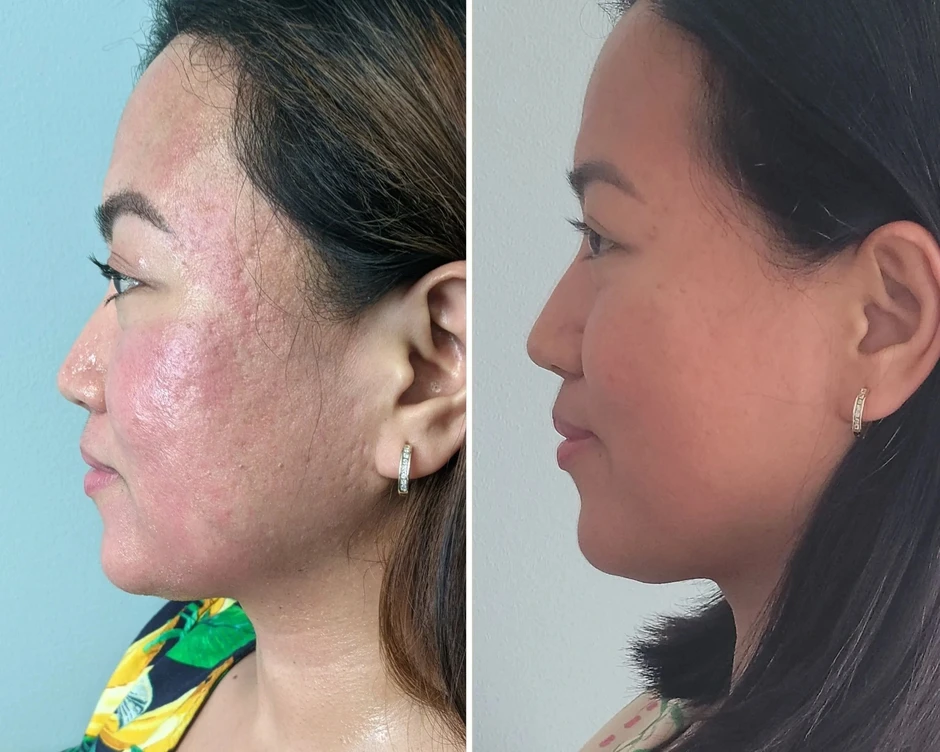 'Cứu' làn da bị sẹo lõm với công nghệ RF Microneedling 'Cứu' làn da bị sẹo lõm với công nghệ RF Microneedling