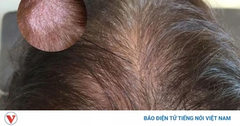 Da đầu yếu, tóc rụng nhiều: Bí quyết phục hồi từ gốc ít ai biết