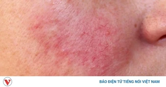 Da mặt đỏ rát: Dấu hiệu cảnh báo gì và xử lý ra sao?