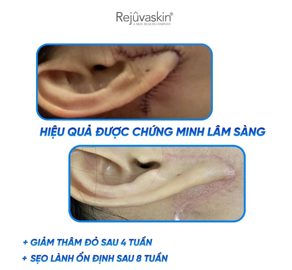Gel Rejuvasil giúp ngăn ngừa sẹo mới và làm mờ sẹo lồi phẫu thuật có tốt không?