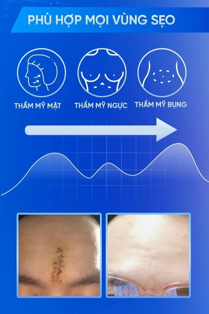 Gel Rejuvasil giúp ngăn ngừa sẹo mới và làm mờ sẹo lồi phẫu thuật có tốt không?