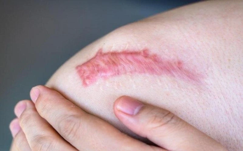 Giải mã ‘cuộc chiến’ vi mô tại vết thương: Khi sự kiểm soát quyết định phục hồi Giải mã ‘cuộc chiến’ vi mô tại vết thương: Khi sự kiểm soát quyết định phục hồi