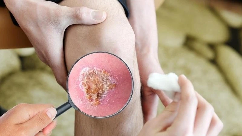 Giải mã ‘cuộc chiến’ vi mô tại vết thương: Khi sự kiểm soát quyết định phục hồi Giải mã ‘cuộc chiến’ vi mô tại vết thương: Khi sự kiểm soát quyết định phục hồi