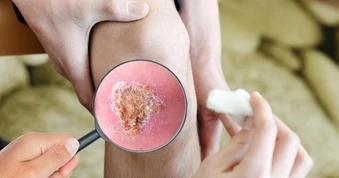 Giải mã ‘cuộc chiến’ vi mô tại vết thương: Khi sự kiểm soát quyết định phục hồi