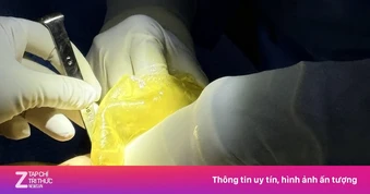 Hai loại túi ngực trên cùng một cơ thể và sự khác biệt sau 14 năm