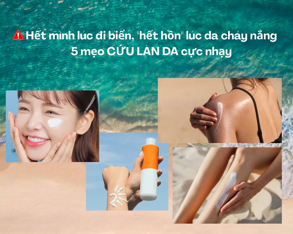 Hết mình lúc đi biển, 'hết hồn' lúc cháy nắng: 5 mẹo cứu làn da cực nhạy Hết mình lúc đi biển, 'hết hồn' lúc cháy nắng: 5 mẹo cứu làn da cực nhạy