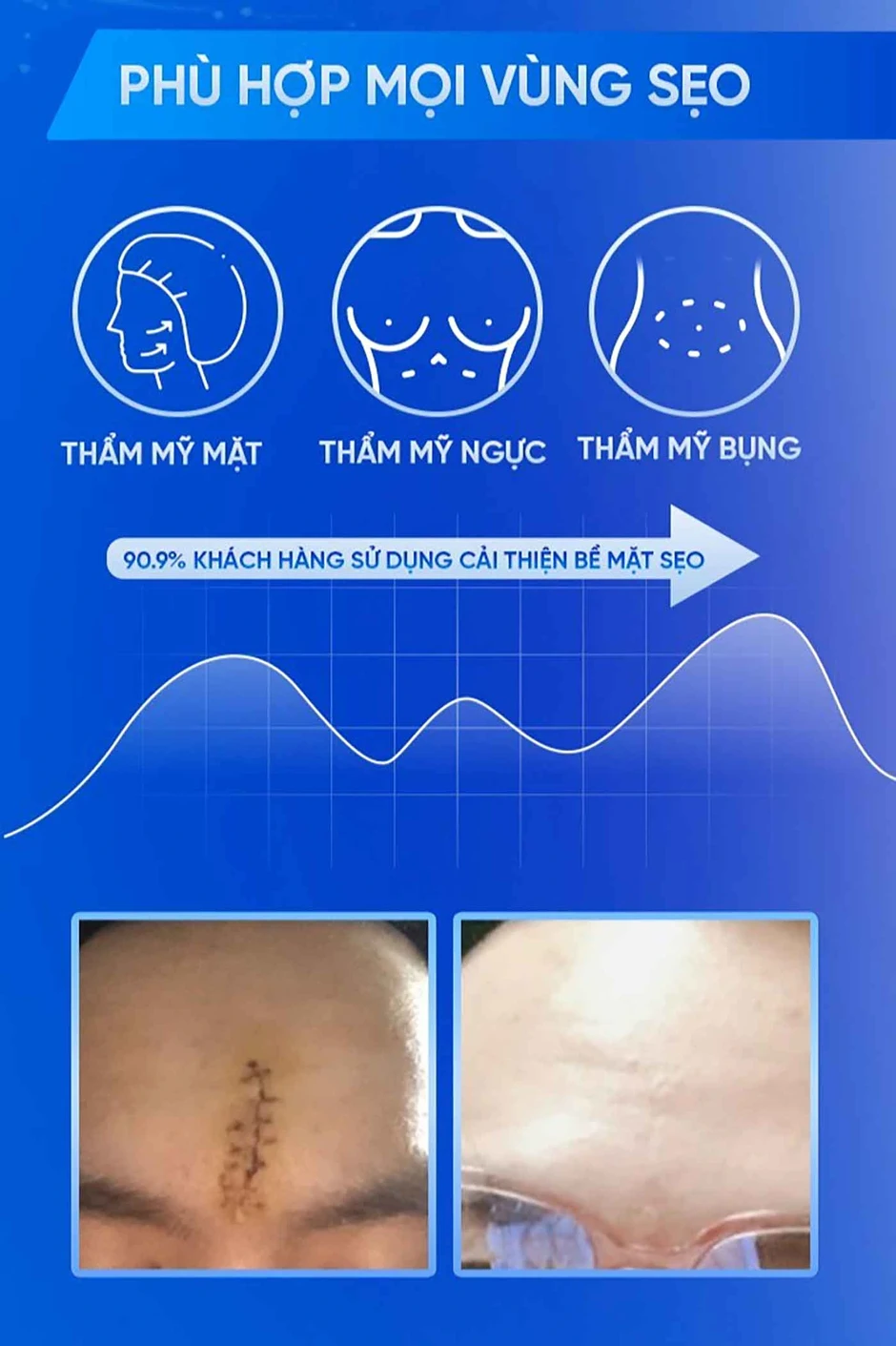 Hướng dẫn sử dụng kem làm mờ sẹo lồi Rejuvasil chuẩn y khoa hiệu quả 4 tuần Hướng dẫn sử dụng kem làm mờ sẹo lồi Rejuvasil chuẩn y khoa hiệu quả 4 tuần
