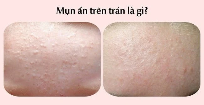 Kem chấm mụn trên trán nào có lượt bán top đầu TikTok hiện nay? Kem chấm mụn trên trán nào có lượt bán top đầu TikTok hiện nay?