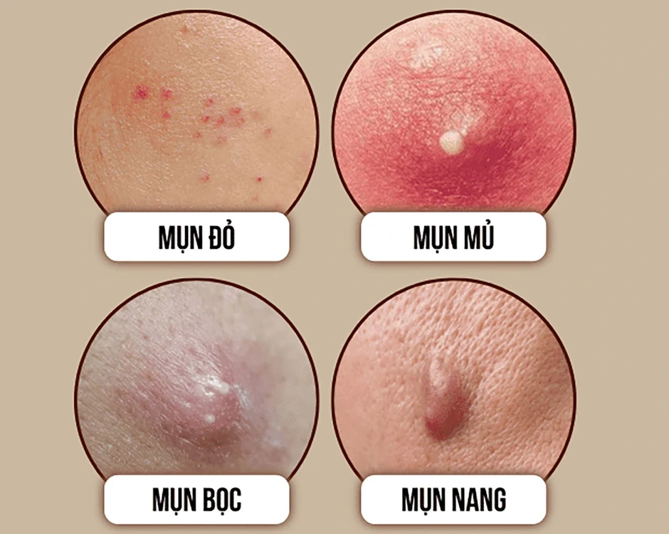 Kem giúp giảm mụn bọc nào đang viral vì hiệu quả sau 4 tuần mà không thâm?