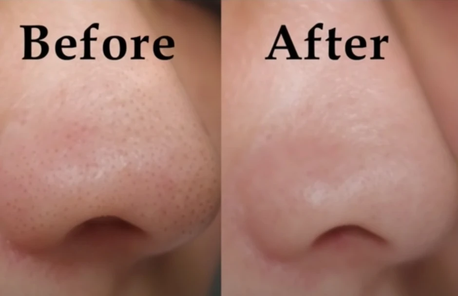 Kem giúp ngừa mụn đầu đen cực đỉnh: Mũi sạch bong, căng bóng như vừa đi spa