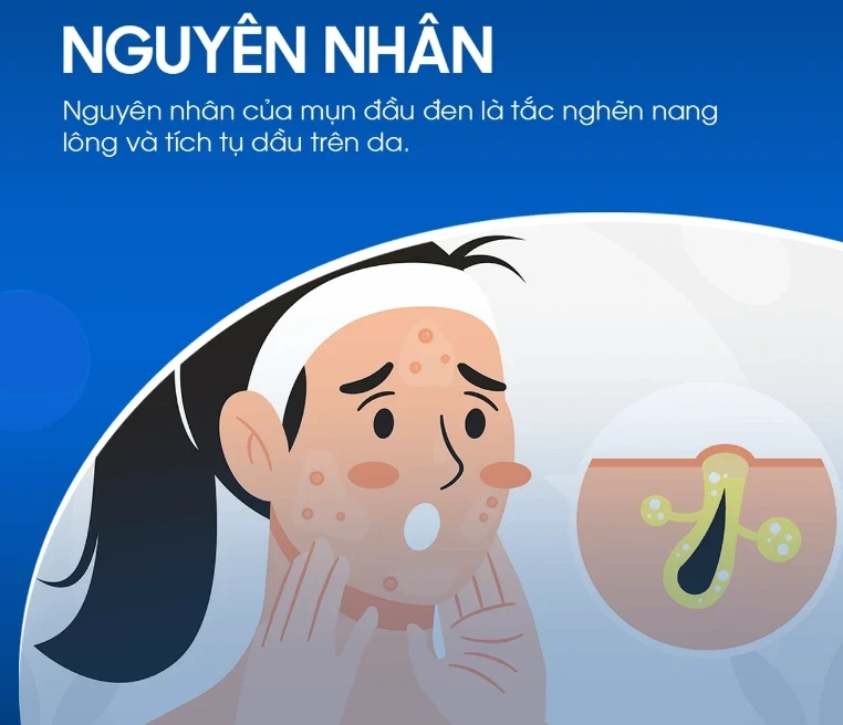 Kem giúp ngừa mụn đầu đen cực đỉnh: Mũi sạch bong, căng bóng như vừa đi spa
