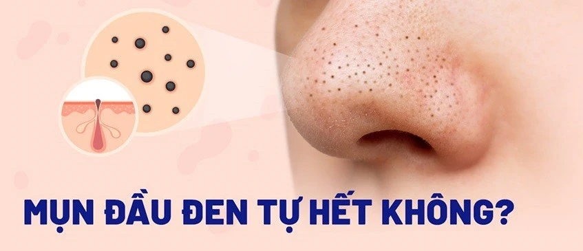 Kem giúp ngừa mụn đầu đen cực đỉnh: Mũi sạch bong, căng bóng như vừa đi spa