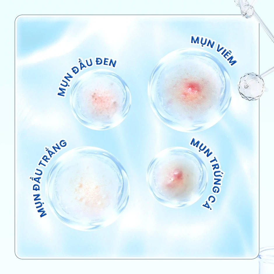 Kem giúp ngừa mụn đầu đen cực đỉnh: Mũi sạch bong, căng bóng như vừa đi spa