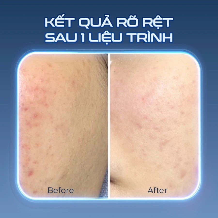 Kháng kháng sinh trong điều trị mụn và giải pháp thay thế từ tia Plasma lạnh Kháng kháng sinh trong điều trị mụn và giải pháp thay thế từ tia Plasma lạnh