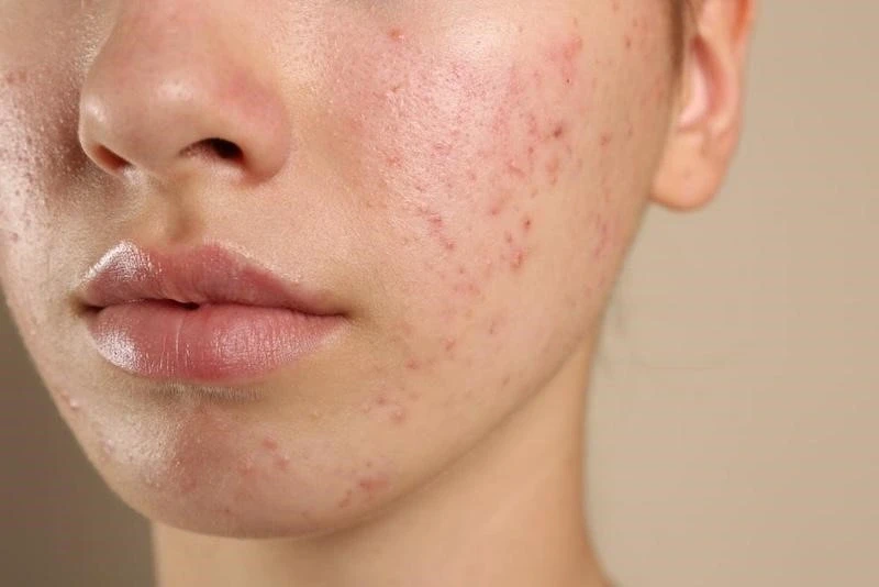 Kháng kháng sinh trong điều trị mụn và giải pháp thay thế từ tia Plasma lạnh Kháng kháng sinh trong điều trị mụn và giải pháp thay thế từ tia Plasma lạnh