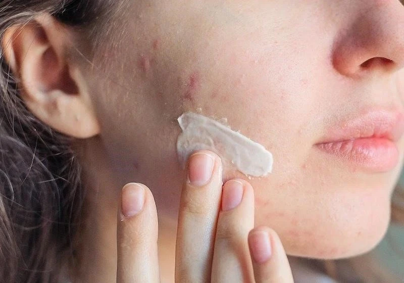 Kháng kháng sinh trong điều trị mụn và giải pháp thay thế từ tia Plasma lạnh Kháng kháng sinh trong điều trị mụn và giải pháp thay thế từ tia Plasma lạnh