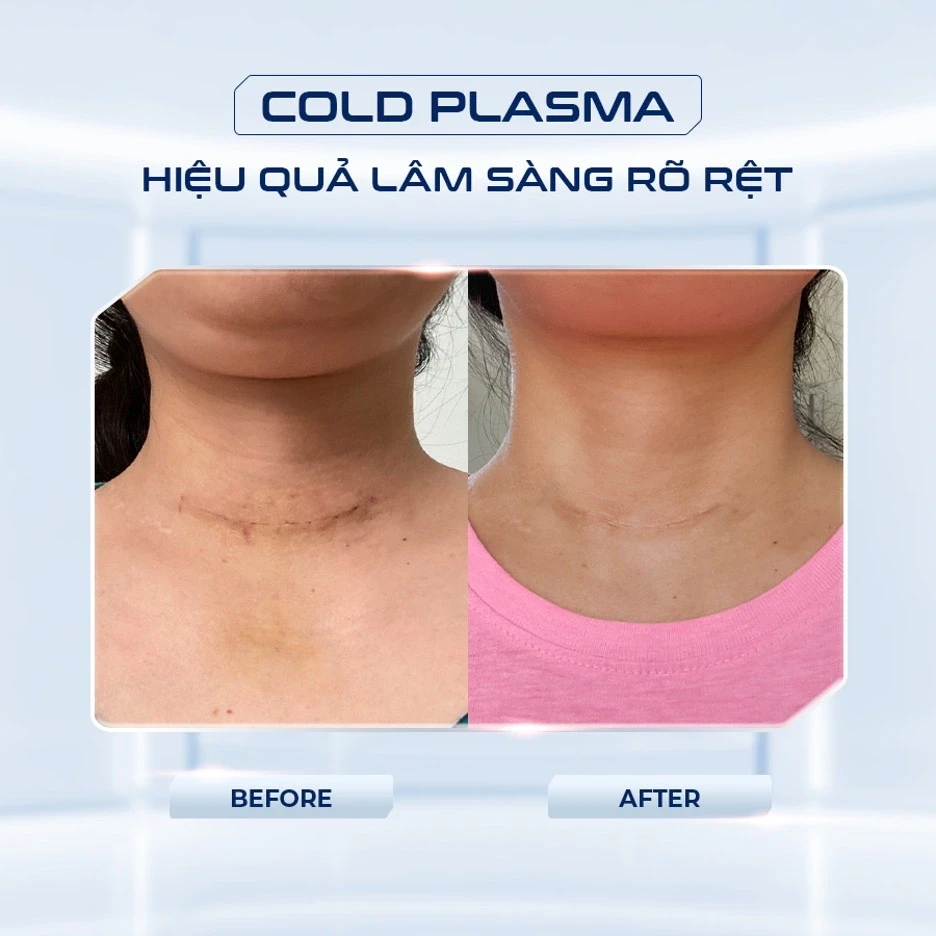 Không còn lo phí vận hành, nhiều spa chọn máy Plasma lạnh không tiêu hao vật tư