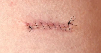 Kiểm soát viêm sau phẫu thuật - Yếu tố quyết định hình thái sẹo