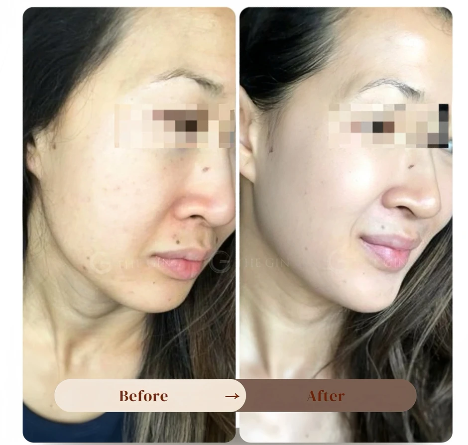 Liệu pháp peel da an toàn được chuyên gia tin tưởng, thay thế filler và botox
