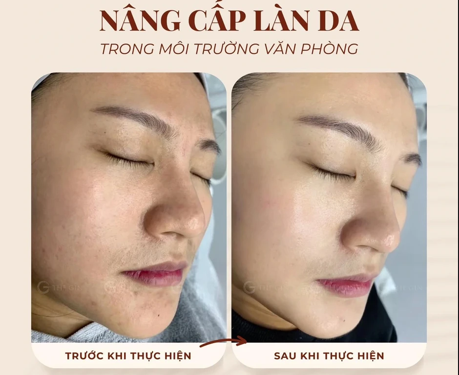Liệu pháp peel da an toàn được chuyên gia tin tưởng, thay thế filler và botox