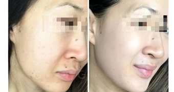 Liệu pháp peel da an toàn được chuyên gia tin tưởng, thay thế filler và botox
