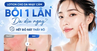 Lotion cho da nhạy cảm: Bôi 1 lần, giúp làm dịu da, giảm đỏ rát thấy rõ