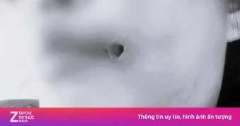 Mặt biến dạng vì hành động mạo hiểm với ổ mủ sau tiêm filler