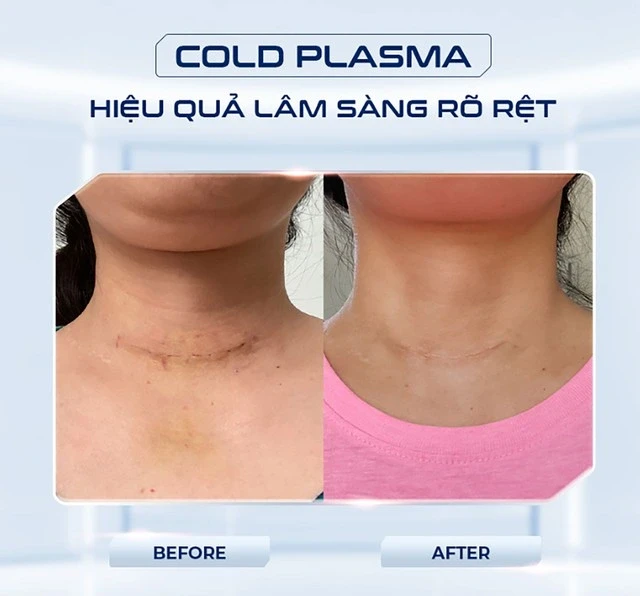 Máy plasma lạnh giá bao nhiêu mà spa, thẩm mỹ viện không tiếc đầu tư? Máy plasma lạnh giá bao nhiêu mà spa, thẩm mỹ viện không tiếc đầu tư?