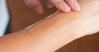 Miếng dán Silicone có thể hỗ trợ điều trị sẹo lồi hiệu quả không?