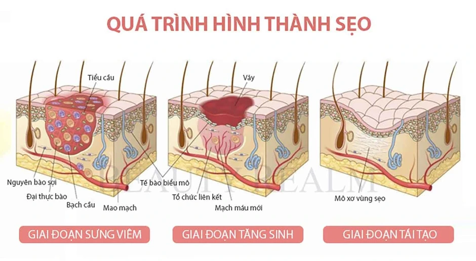 Nam giới bị sẹo rỗ: Khi nào da còn khả năng tăng sinh collagen để cải thiện? Nam giới bị sẹo rỗ: Khi nào da còn khả năng tăng sinh collagen để cải thiện?