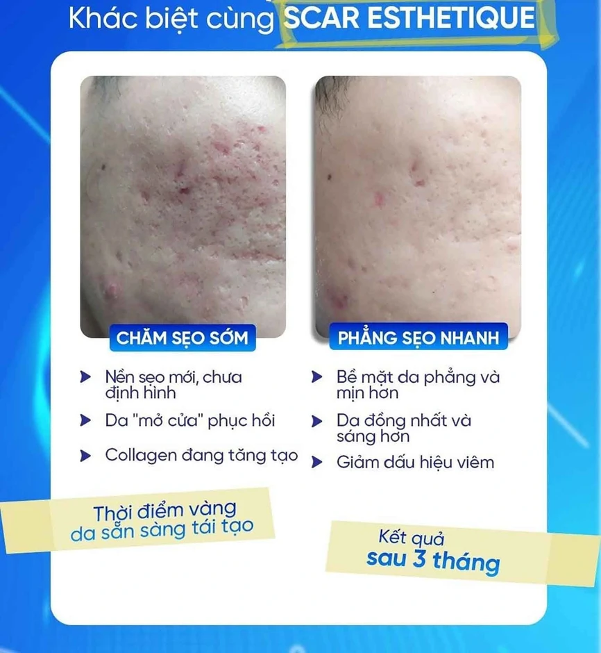 Nam giới bị sẹo rỗ: Khi nào da còn khả năng tăng sinh collagen để cải thiện? Nam giới bị sẹo rỗ: Khi nào da còn khả năng tăng sinh collagen để cải thiện?
