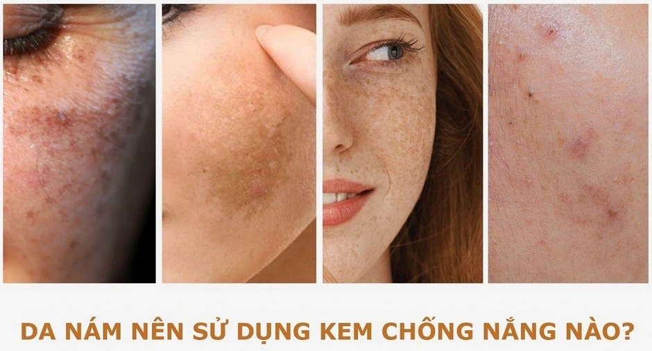 Nám tái đi tái lại do chưa ‘update’ 3 kem chống nắng cho da nám dưới đây! Nám tái đi tái lại do chưa ‘update’ 3 kem chống nắng cho da nám dưới đây!