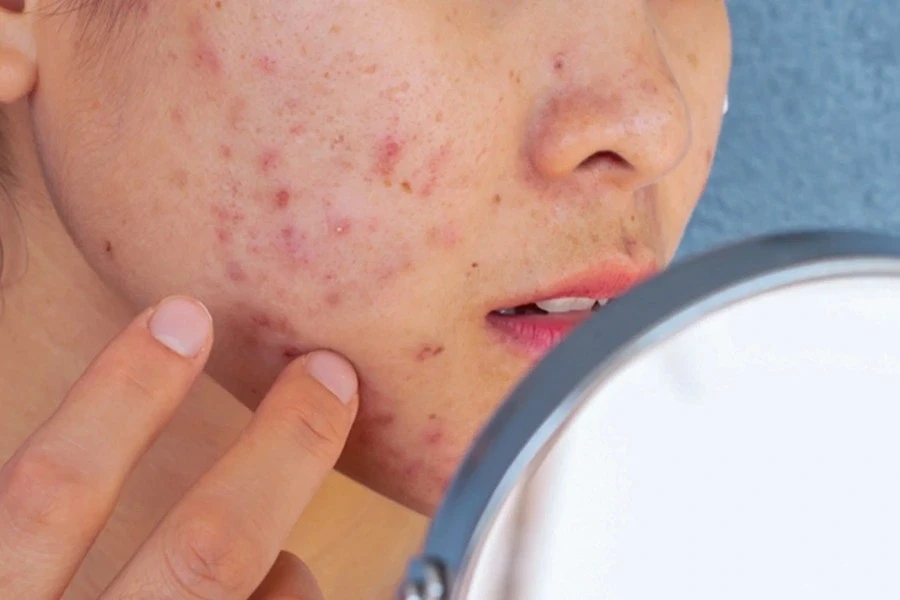 Nắng nóng đỉnh điểm kéo dài: Da dầu mụn vì sao càng skincare mụn càng bùng phát? Nắng nóng đỉnh điểm kéo dài: Da dầu mụn vì sao càng skincare mụn càng bùng phát?