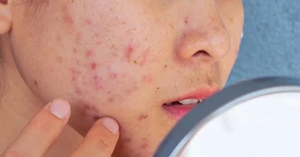 Nắng nóng đỉnh điểm kéo dài: Da dầu mụn vì sao càng skincare mụn càng bùng phát?