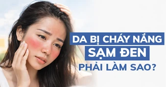 Nắng nóng gần 40 độ: Da bỏng rát, sạm màu? Cách phục hồi sau 1 đêm