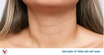 Nếp nhăn ở cổ ngày càng sâu: Làm sao cải thiện hiệu quả?