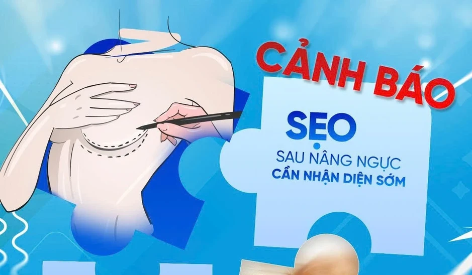 Phẫu thuật thẩm mỹ ngực: Đừng để hành trình tìm lại tự tin ‘đứt gánh’ vì sẹo Phẫu thuật thẩm mỹ ngực: Đừng để hành trình tìm lại tự tin ‘đứt gánh’ vì sẹo