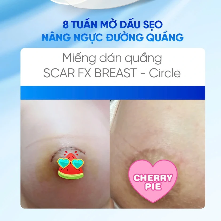Phẫu thuật treo sa trễ dùng miếng dán silicone nào để da phẳng như chưa dao kéo?