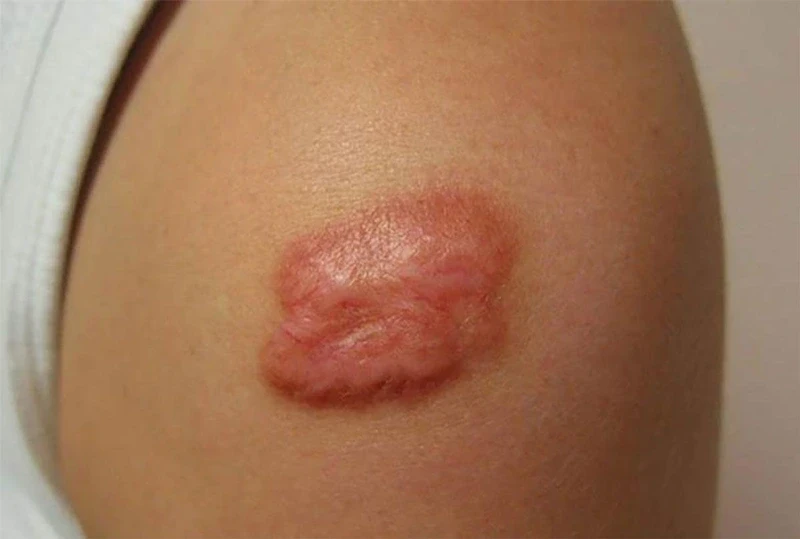Quản trị rủi ro biến chứng hậu phẫu: Góc nhìn từ công nghệ Plasma lạnh Quản trị rủi ro biến chứng hậu phẫu: Góc nhìn từ công nghệ Plasma lạnh
