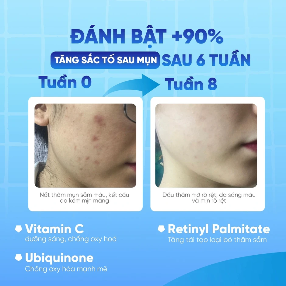 Review chi tiết kem Scar Esthetique làm mờ sẹo rỗ do mụn có tốt không? Review chi tiết kem Scar Esthetique làm mờ sẹo rỗ do mụn có tốt không?
