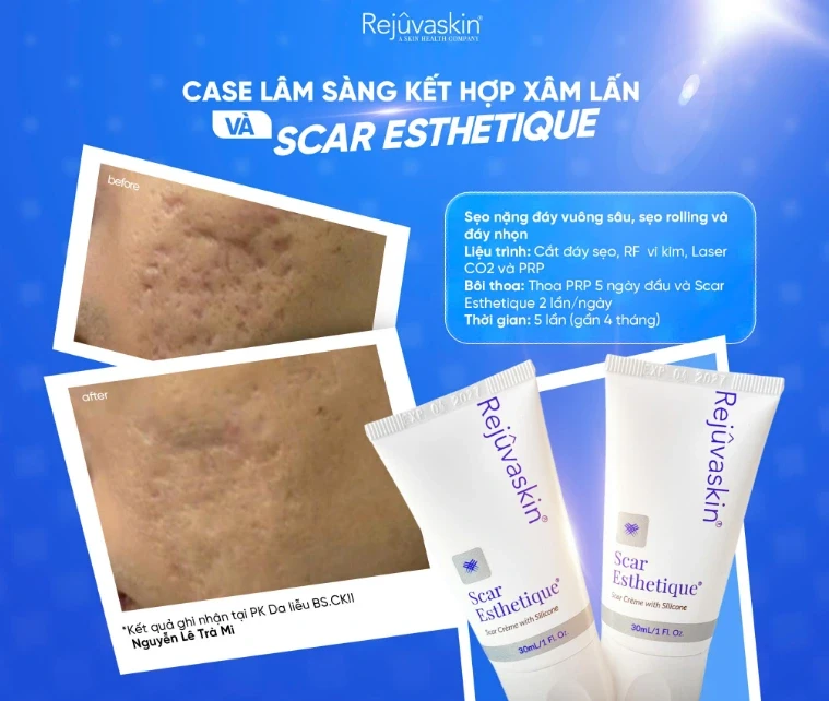 Review chi tiết kem Scar Esthetique làm mờ sẹo rỗ do mụn có tốt không? Review chi tiết kem Scar Esthetique làm mờ sẹo rỗ do mụn có tốt không?