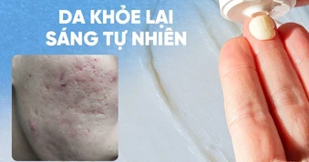 Review chi tiết kem Scar Esthetique làm mờ sẹo rỗ do mụn có tốt không?
